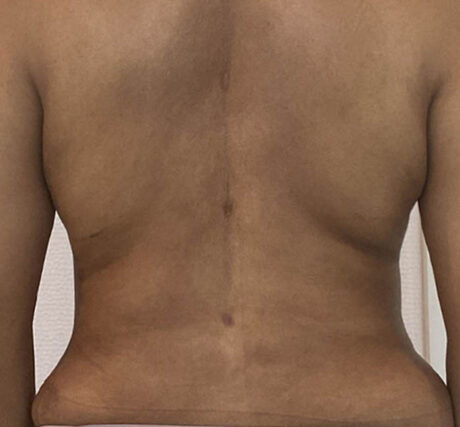 Liposuction case #5700