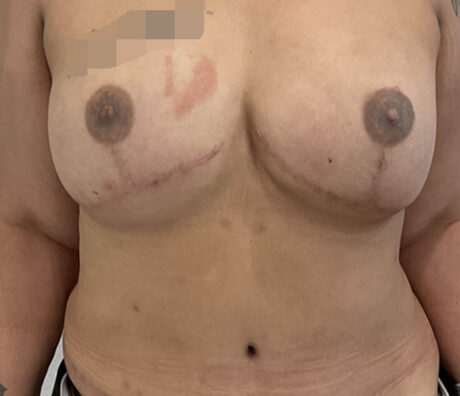 Breast Reconstruction case #5920