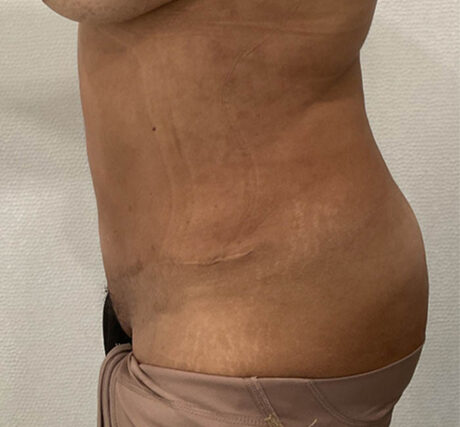 Liposuction case #5886