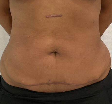 Liposuction case #5670