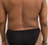 Liposuction case #5671