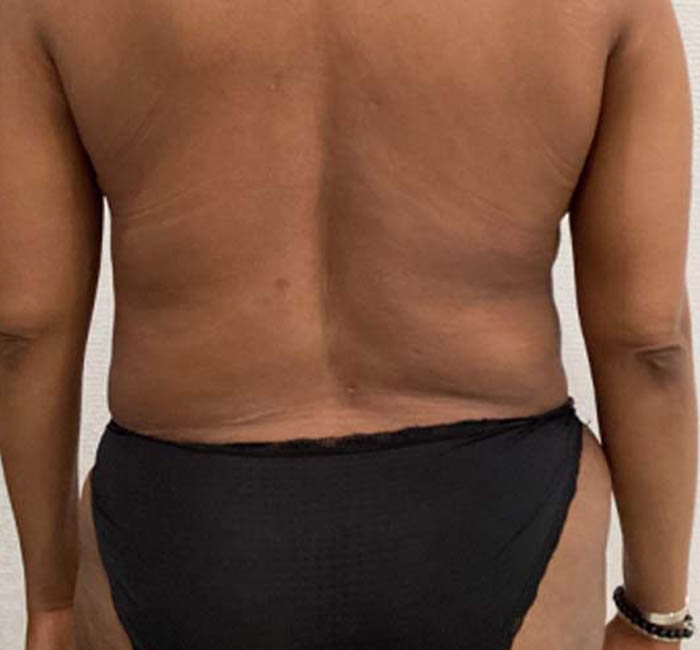 Liposuction case #5671