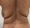 Liposuction case #5700
