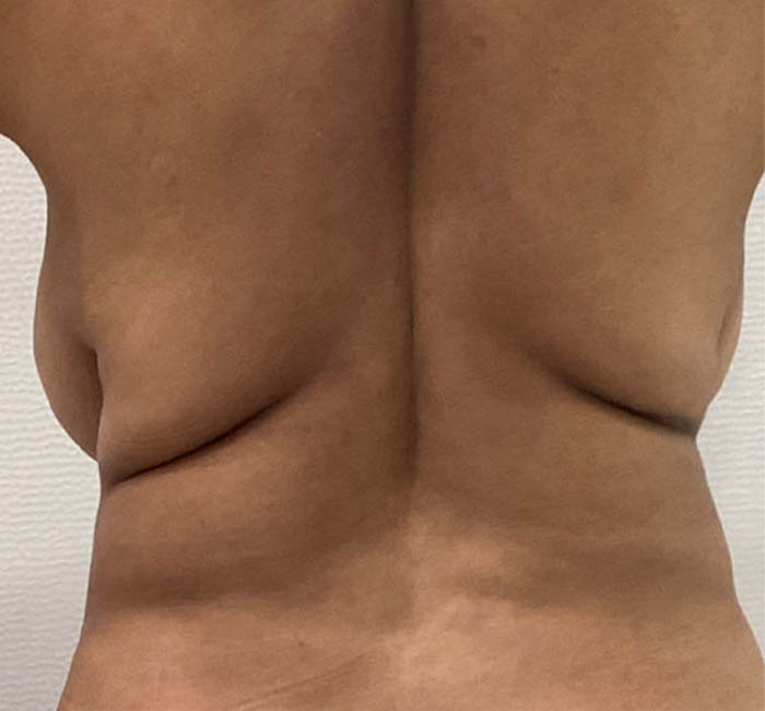 Liposuction case #5700