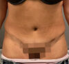 Liposuction case #5886
