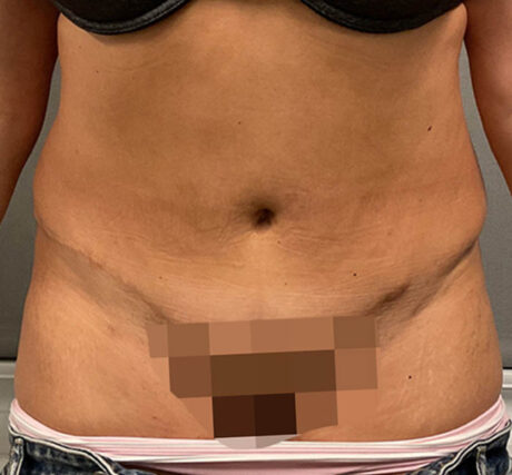 Liposuction case #5886