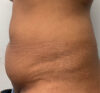 Liposuction case #5670