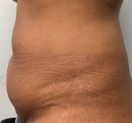 Liposuction case #5670