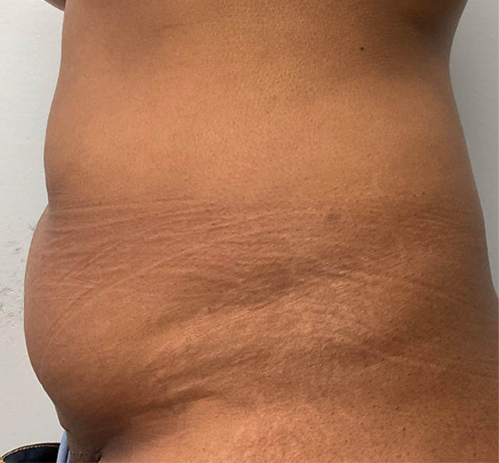 Liposuction case #5670