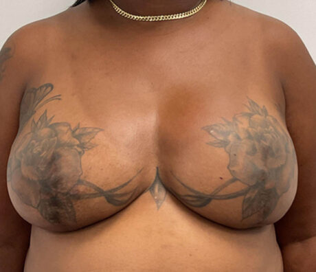 Breast Reconstruction case #5914