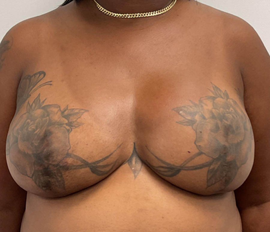 Breast Reconstruction case #5914