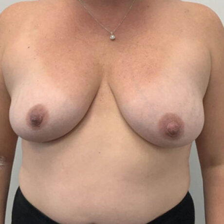 Breast Augmentation case #5909