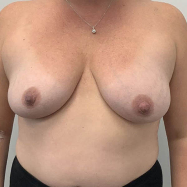 Breast Augmentation case #5909