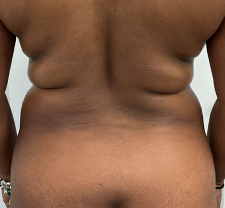 Liposuction case #5879