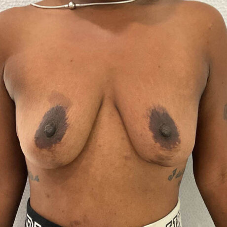 Breast Implant Revision case #5746
