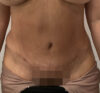 Liposuction case #5886