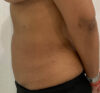Liposuction case #5670