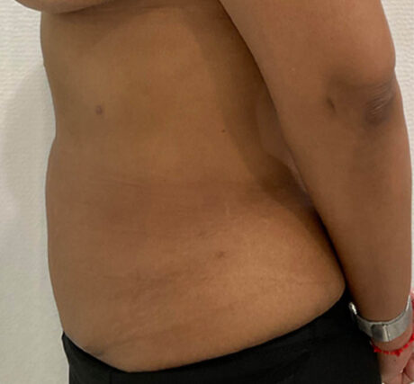 Liposuction case #5670