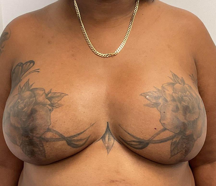 Breast Reconstruction case #5914