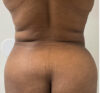 Liposuction case #5879