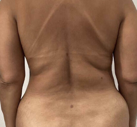 Liposuction case #5886