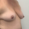 Breast Augmentation case #5909