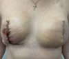 Breast Reconstruction case #5917
