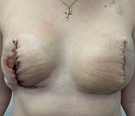 Breast Reconstruction case #5917