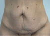 Tummy Tuck case #6107