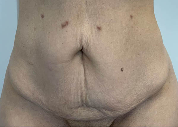 Tummy Tuck case #6107