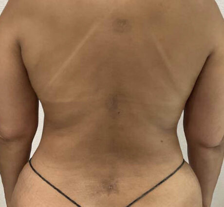 Liposuction case #5893