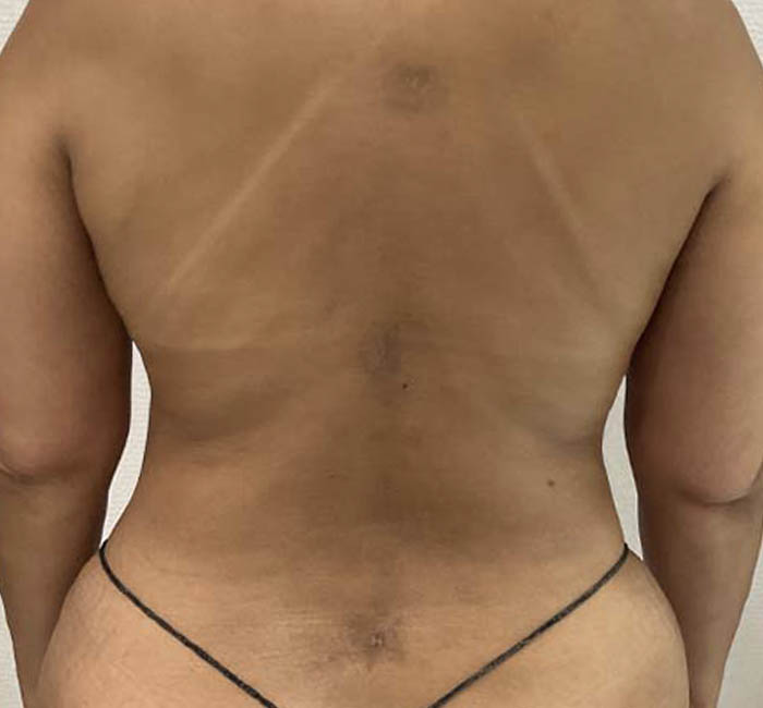 Liposuction case #5893