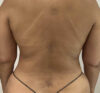 Liposuction case #5886