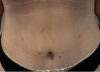 Tummy Tuck case #6107