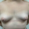 Tuberous Breast Deformity case #6117