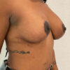 Breast Implant Revision case #5746
