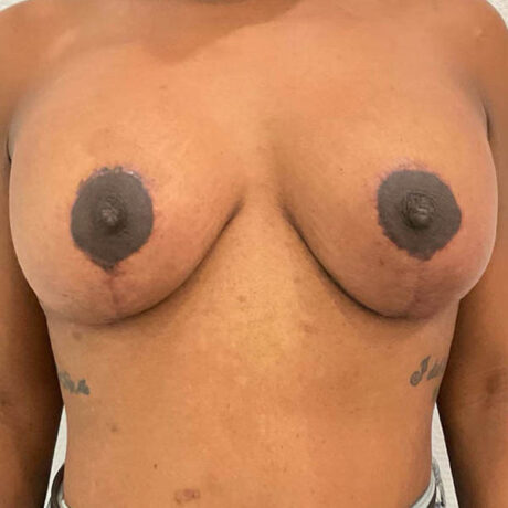 Breast Implant Revision case #5746
