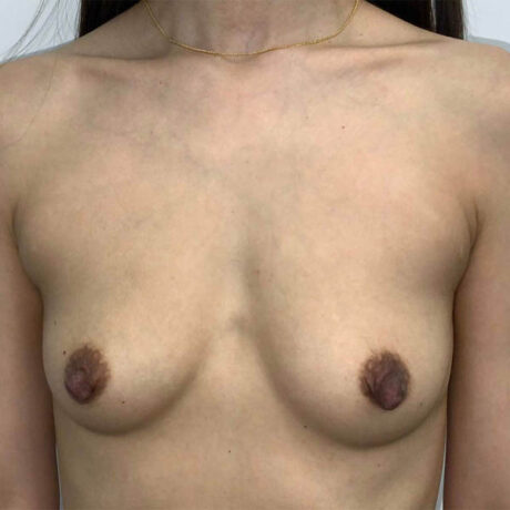 Breast Augmentation case #6122