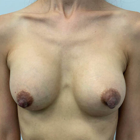 Breast Augmentation case #6122