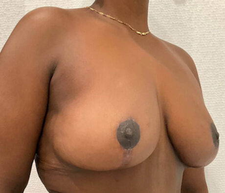 Breast Lift case #5785