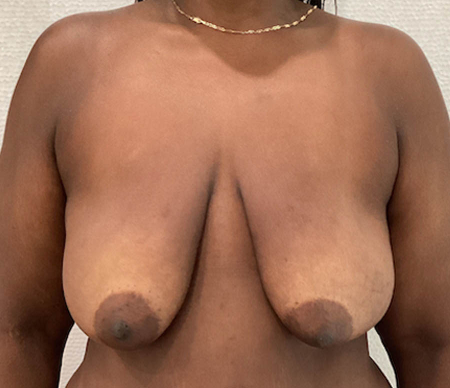 Breast Lift case #5785