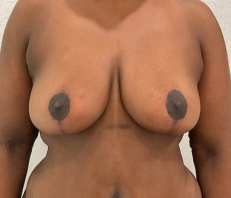 Breast Lift case #5785