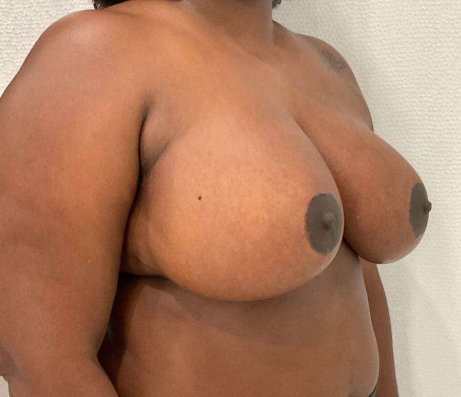 Breast Reduction case #5751