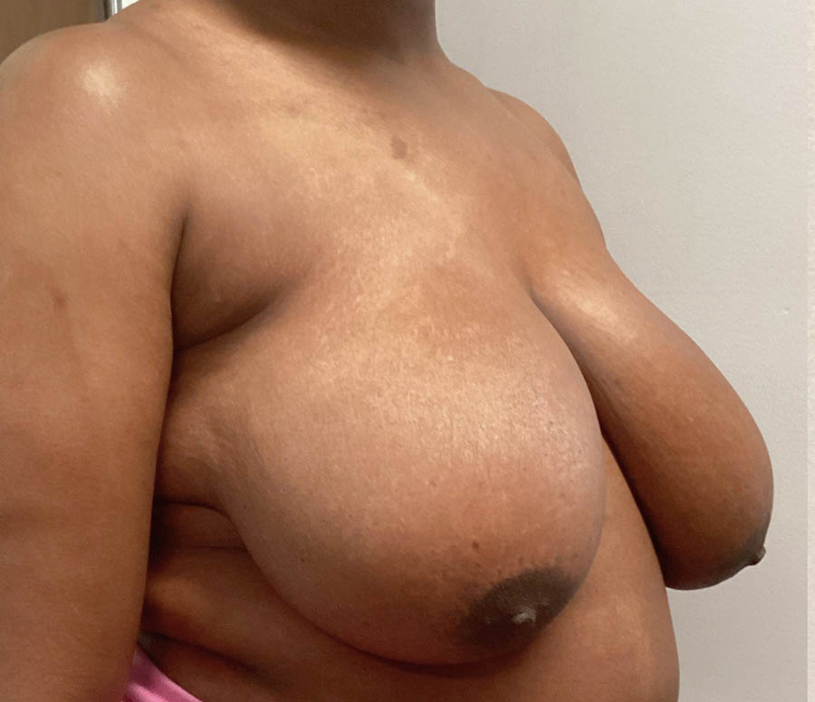 Breast Reduction case #5768