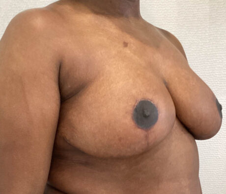 Breast Reduction case #5768
