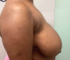 Breast Reduction case #5768