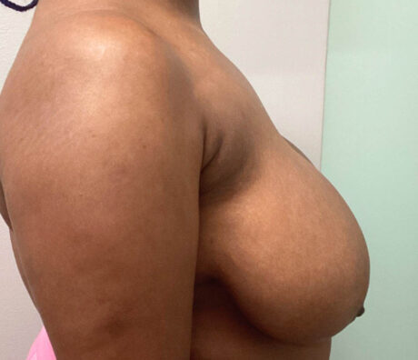 Breast Reduction case #5768