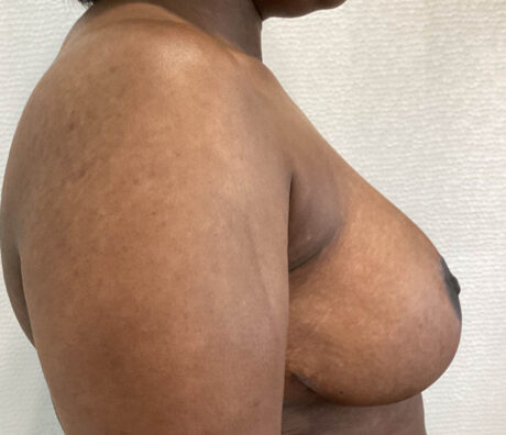 Breast Reduction case #5768