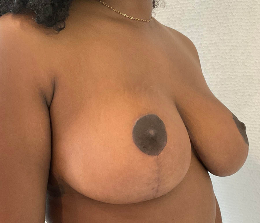 Breast Reconstruction case #5761