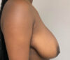 Breast Reconstruction case #5761